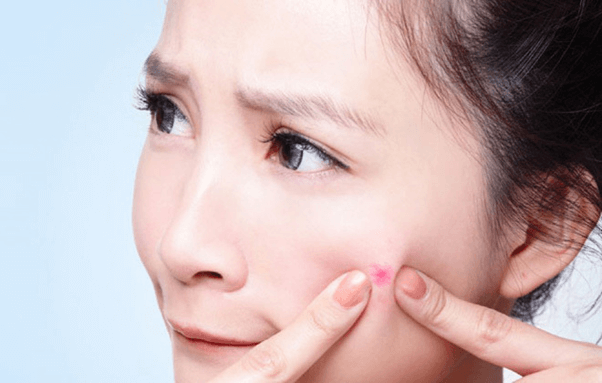 Cách nặn mụn ẩn tại nhà