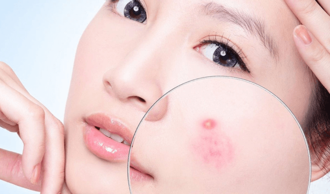 Điều trị mụn giá rẻ, uy tín