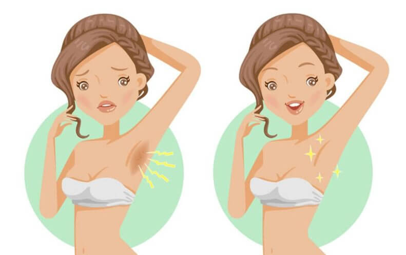 Bị thâm nách do cạo lông nách