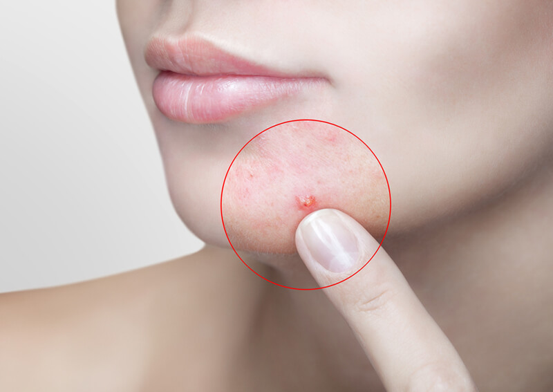 Điều trị mụn nội tiết
