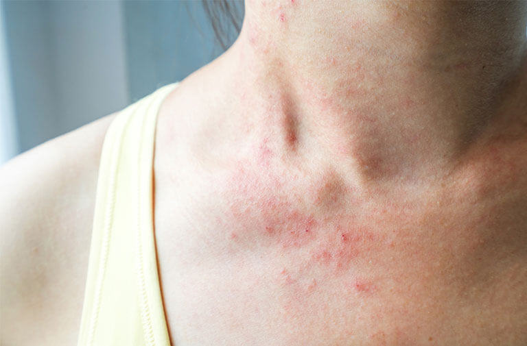 Loại bỏ mụn ở ngực