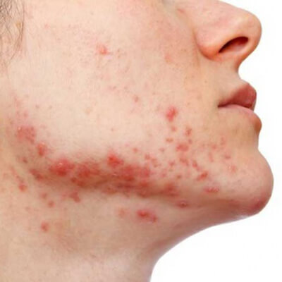 Điều trị mụn do nội tiết tố